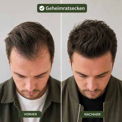 Capiluxe™ Haarregenerations-System