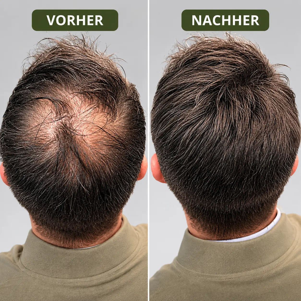 Capiluxe™ Haarregenerations-System